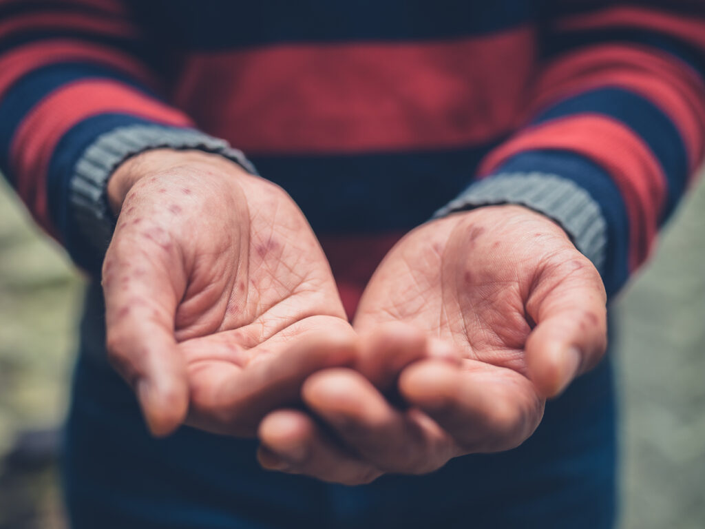 Close up on the hands of a young man with a rash on his hands begging outside